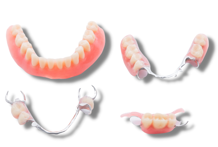 Denver Removable Teeth, Implants, & Dentures: Vitallium & Valplast